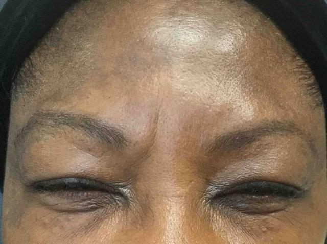 Botox after at Juno Aesthetics (Julia Giyaur, MD) in Brooklyn, NY
