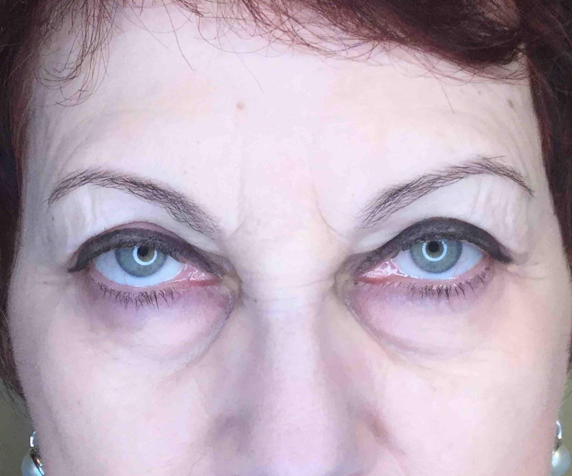 Juno Aesthetics (Julia Giyaur, MD) under-eye filler after — Brooklyn, NY