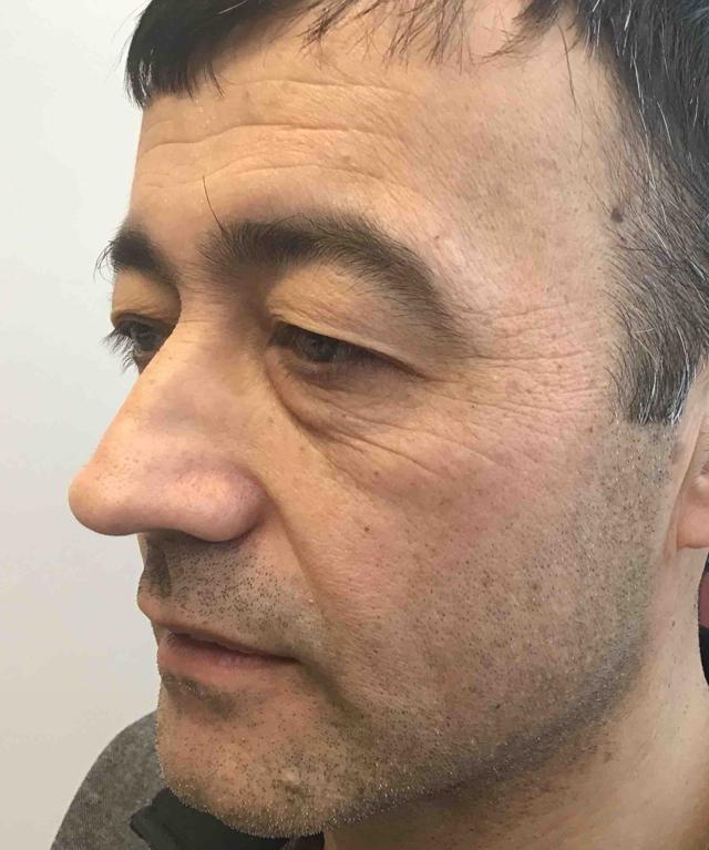 Blepharoplasty before at Juno Aesthetics (Julia Giyaur, MD) in Brooklyn, NY