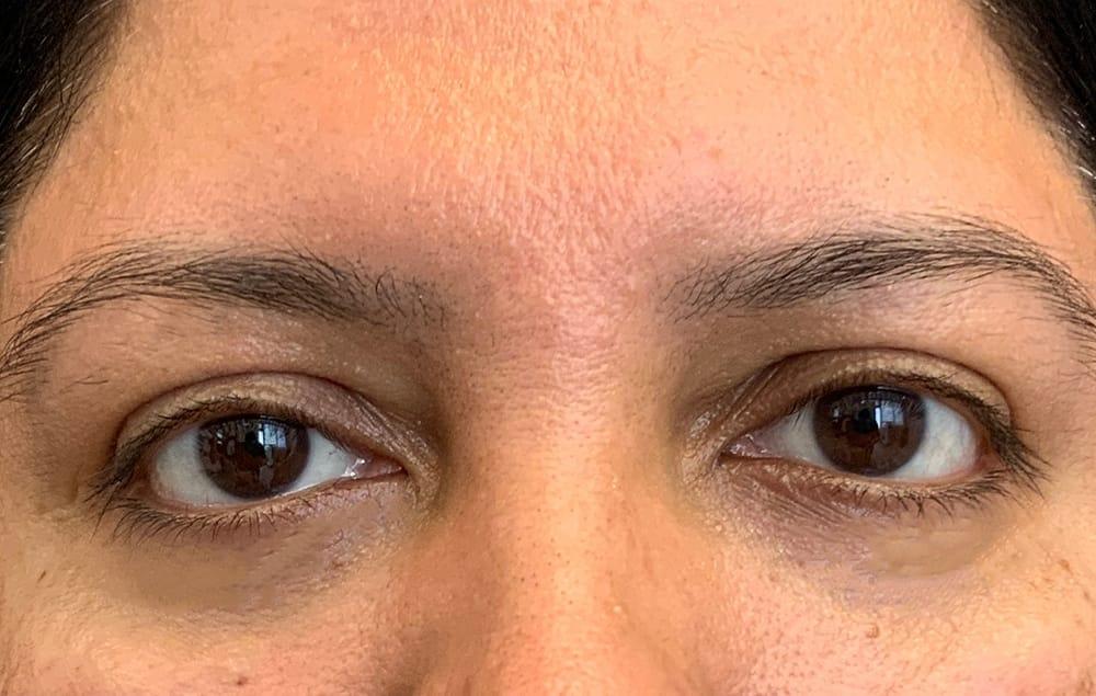 Juno Aesthetics (Julia Giyaur, MD) under-eye filler after — Brooklyn, NY
