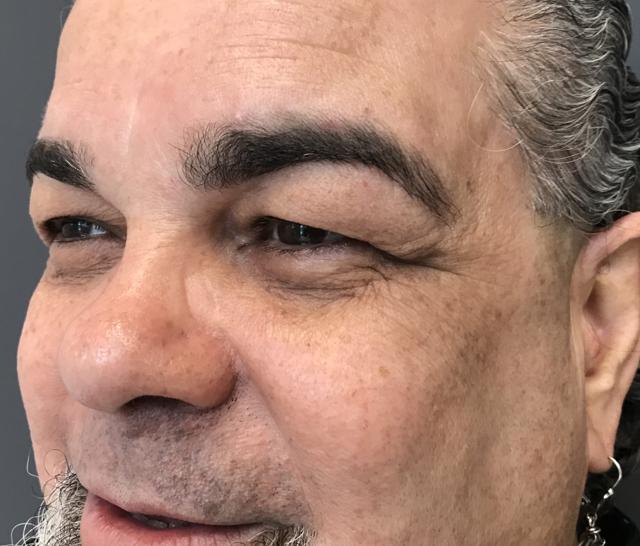 Blepharoplasty after at Juno Aesthetics (Julia Giyaur, MD) in Brooklyn, NY