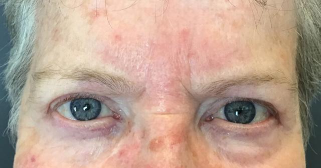 Botox after at Juno Aesthetics (Julia Giyaur, MD) in Brooklyn, NY