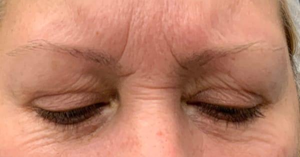 Botox before at Juno Aesthetics (Julia Giyaur, MD) in Brooklyn, NY