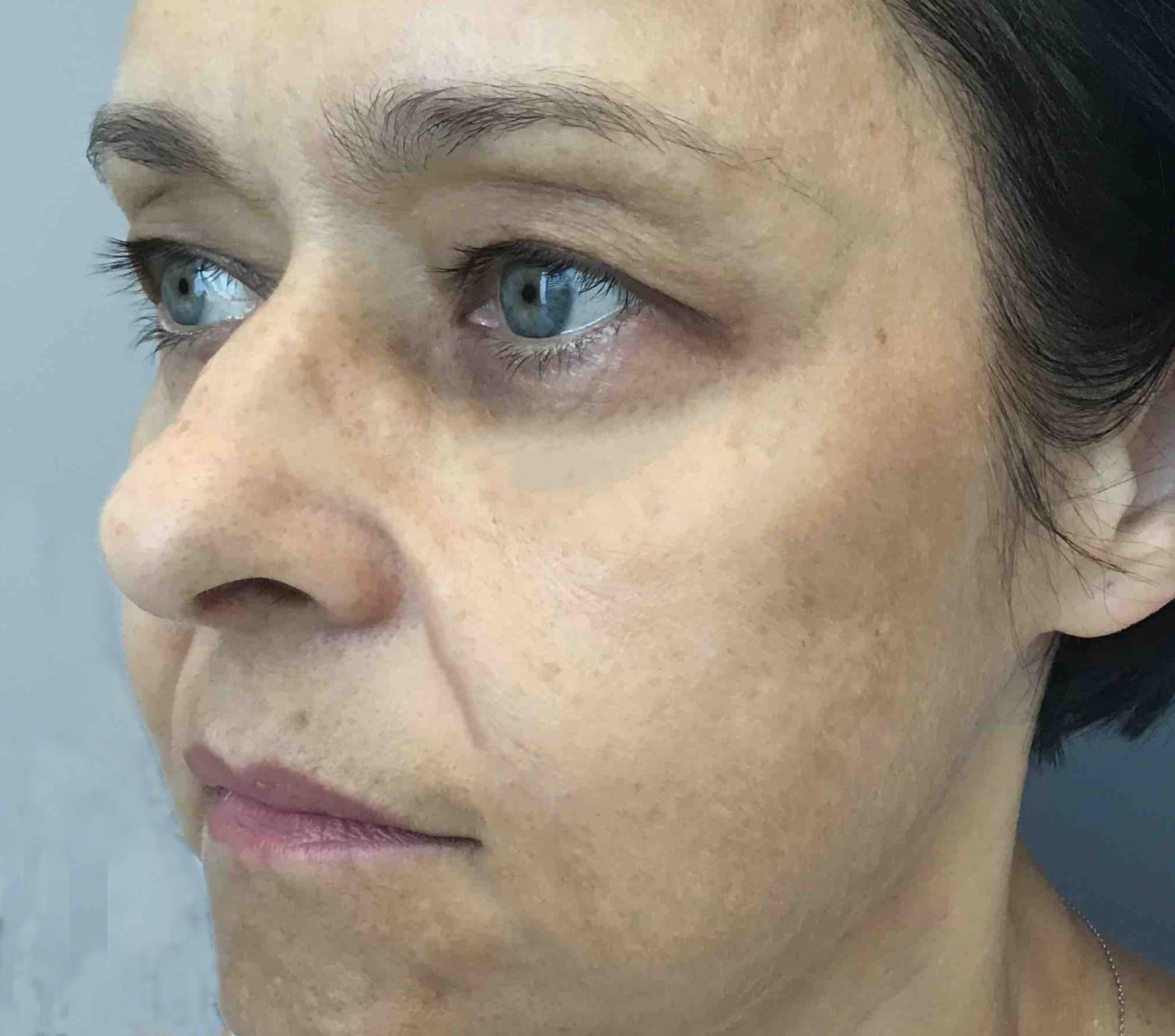 Juno Aesthetics (Julia Giyaur, MD) under-eye filler after — Brooklyn, NY