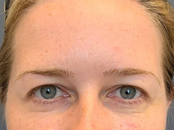 Botox before at Juno Aesthetics (Julia Giyaur, MD) in Brooklyn, NY