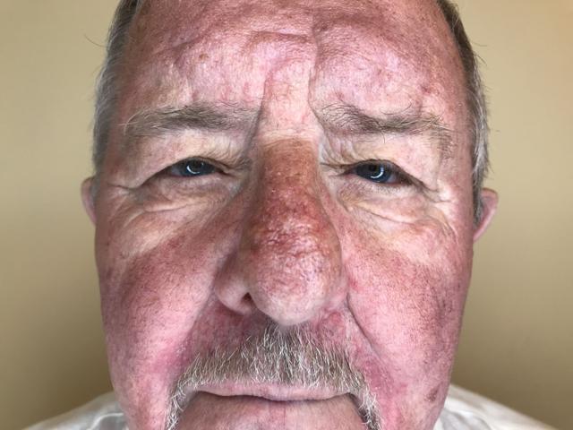 Blepharoplasty before at Juno Aesthetics (Julia Giyaur, MD) in Brooklyn, NY