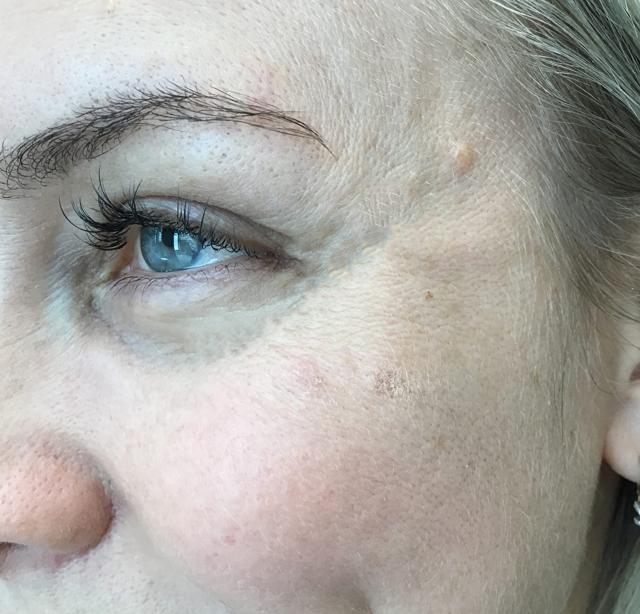 Botox after at Juno Aesthetics (Julia Giyaur, MD) in Brooklyn, NY