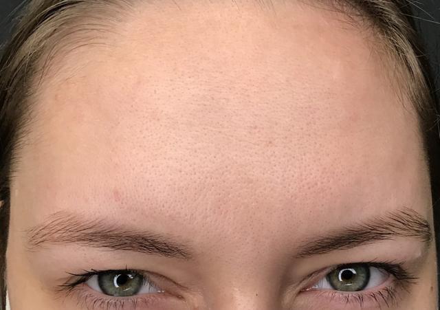 Botox after at Juno Aesthetics (Julia Giyaur, MD) in Brooklyn, NY