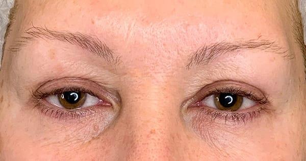 Botox after at Juno Aesthetics (Julia Giyaur, MD) in Brooklyn, NY