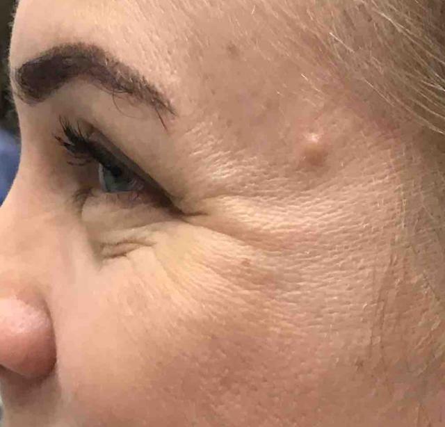 Botox before at Juno Aesthetics (Julia Giyaur, MD) in Brooklyn, NY