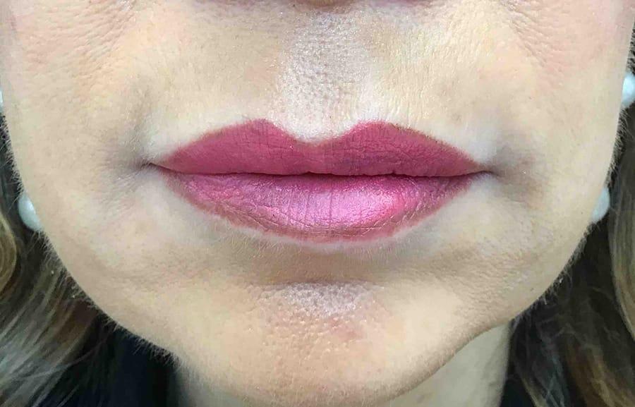 Juno Aesthetics (Julia Giyaur, MD) lip filler after — Brooklyn, NY