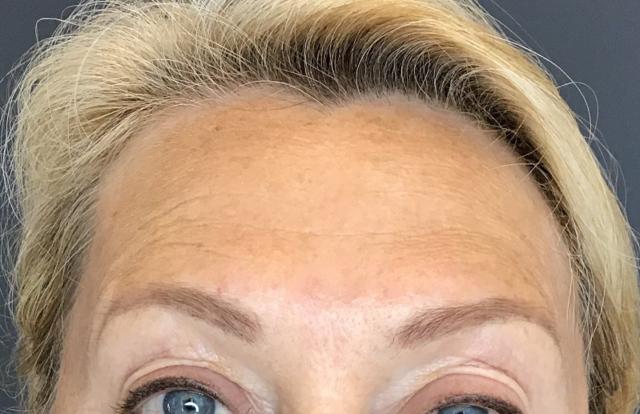 Botox after at Juno Aesthetics (Julia Giyaur, MD) in Brooklyn, NY