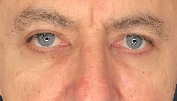 Juno Aesthetics (Julia Giyaur, MD) eyelid lift after — Brooklyn, NY