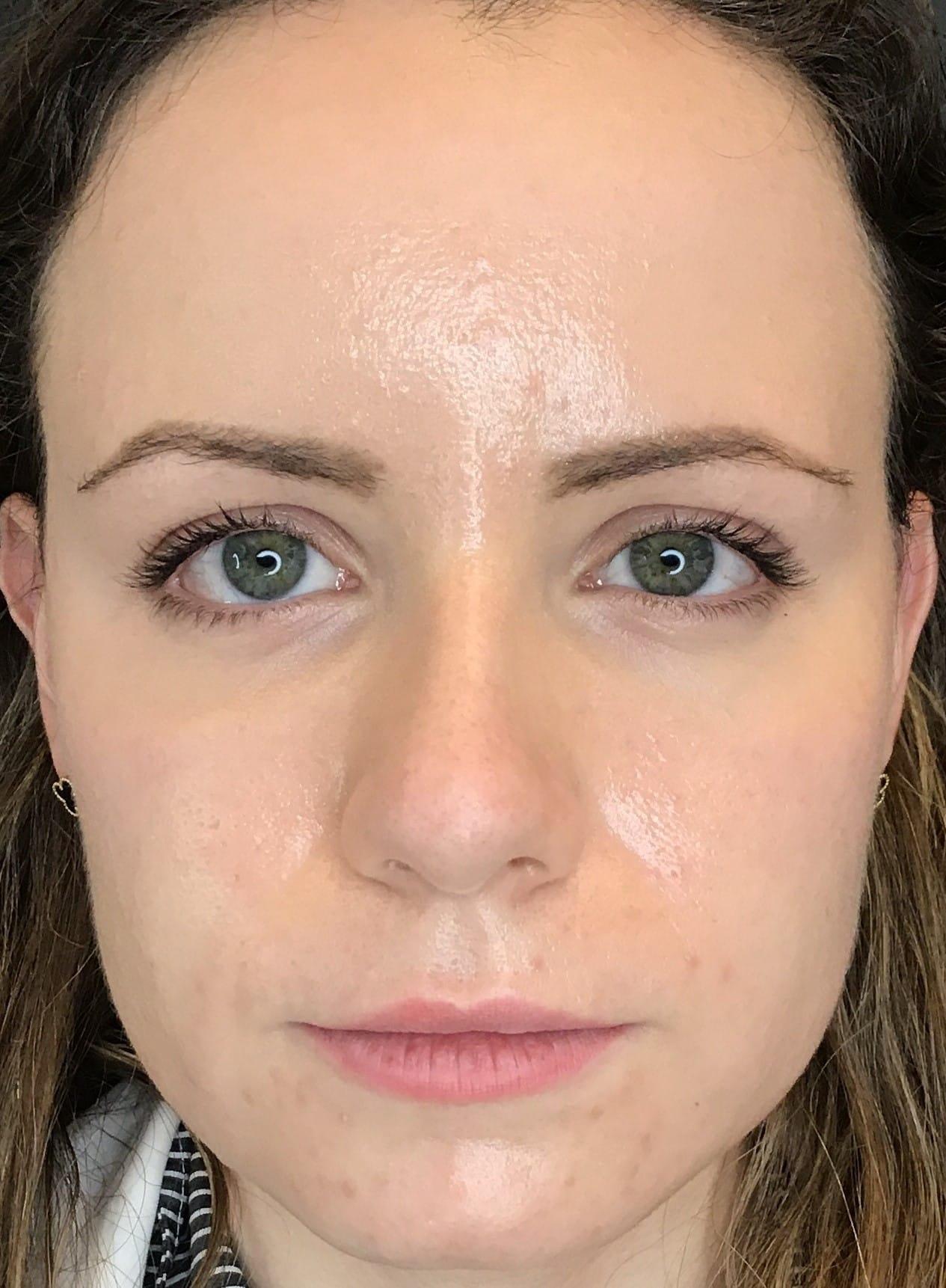 Juno Aesthetics (Julia Giyaur, MD) under-eye filler after — Brooklyn, NY
