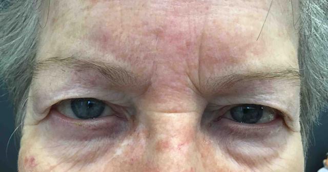 Botox before at Juno Aesthetics (Julia Giyaur, MD) in Brooklyn, NY