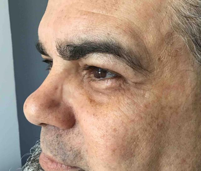 Blepharoplasty before at Juno Aesthetics (Julia Giyaur, MD) in Brooklyn, NY