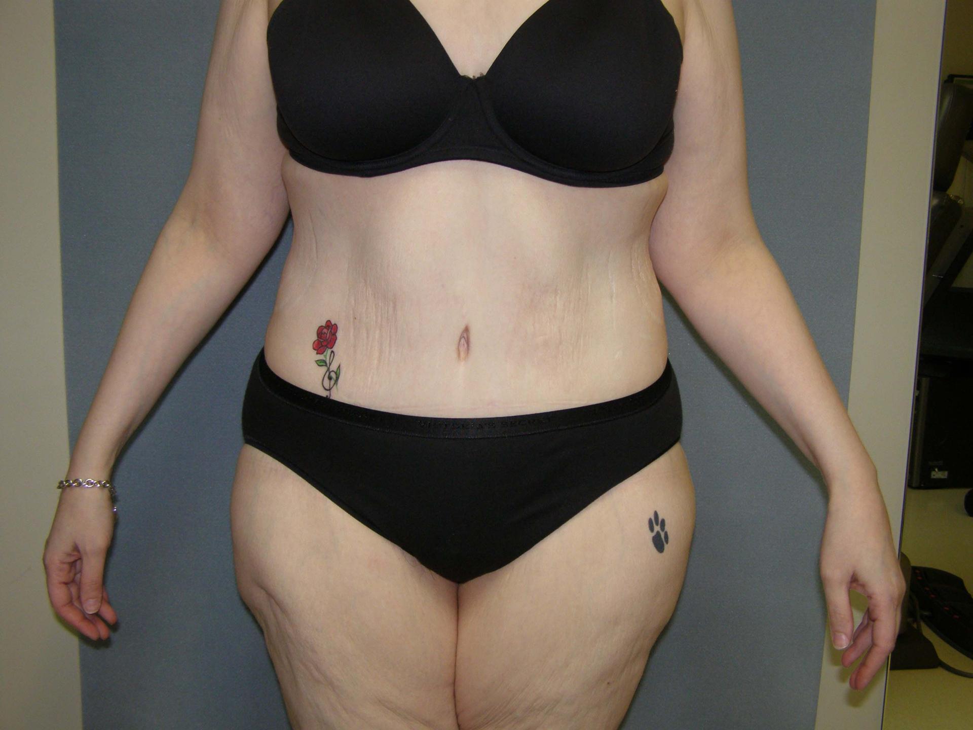 David Abramson, MD tummy tuck after — Englewood, NJ