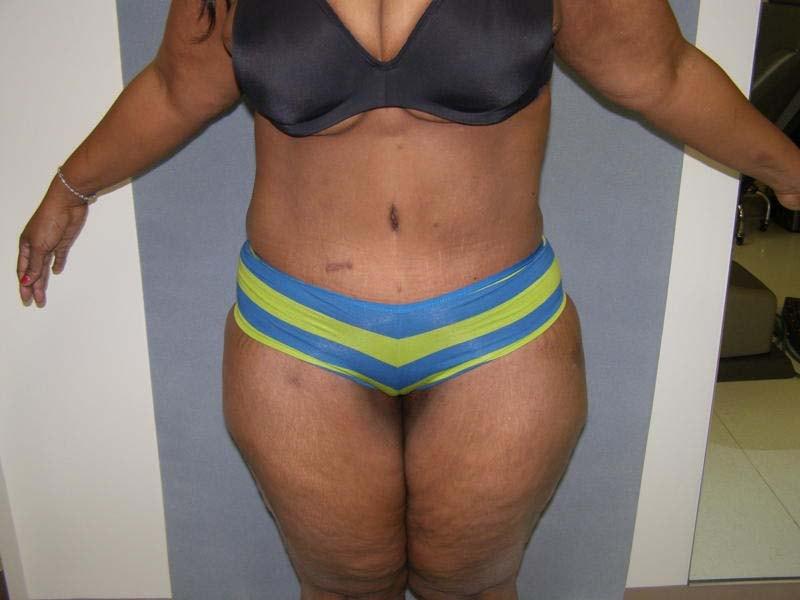 David Abramson, MD tummy tuck after — Englewood, NJ