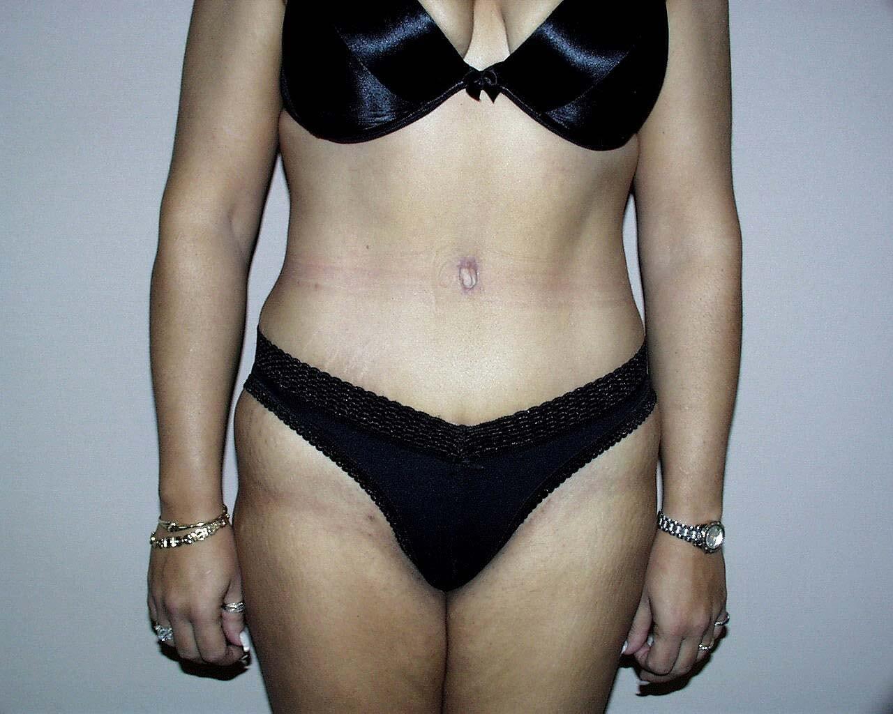David Abramson, MD tummy tuck after — Englewood, NJ