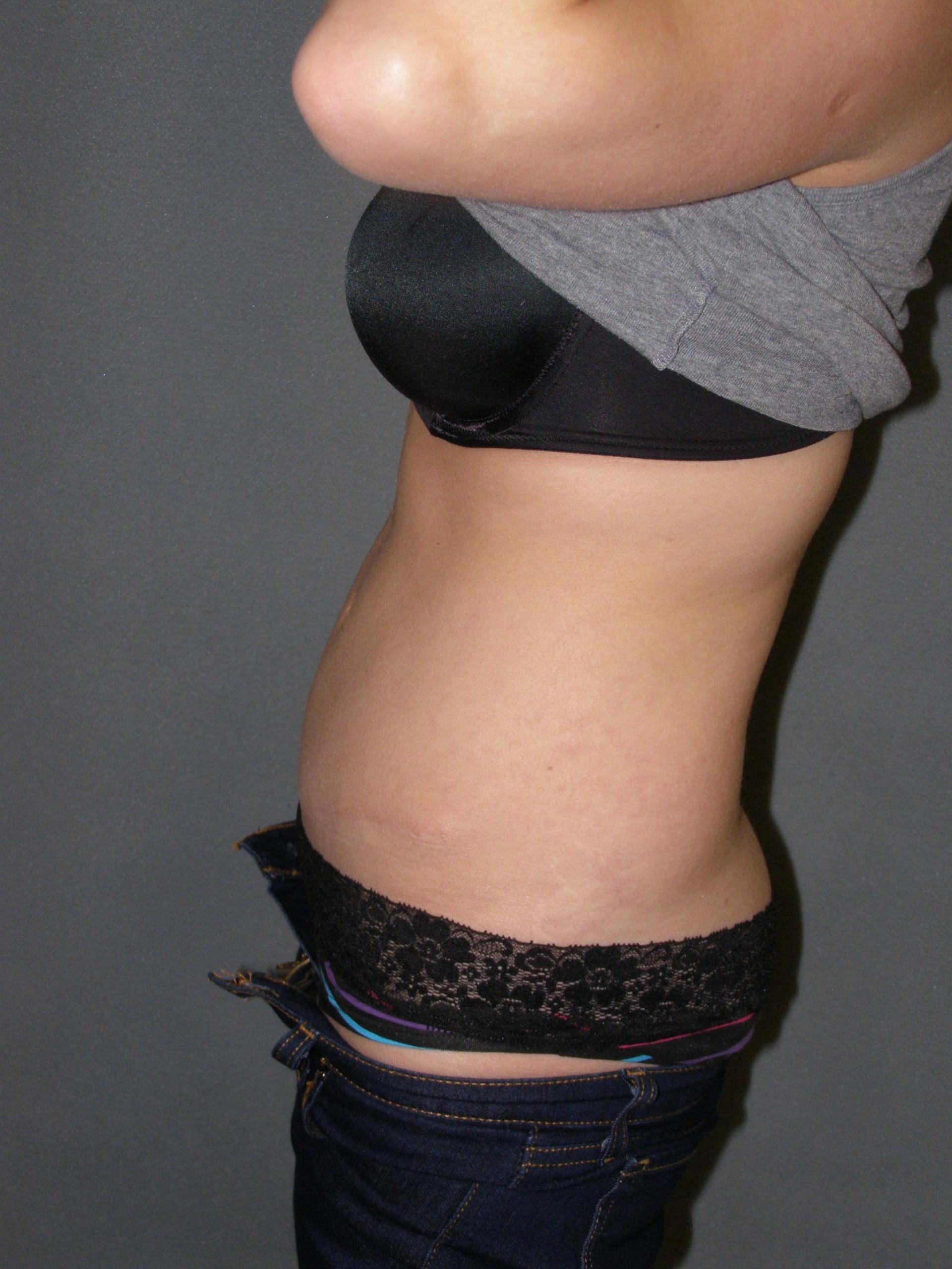David Abramson, MD tummy tuck after — Englewood, NJ