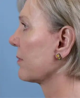Hamilton Facial Plastic Surgery after — Indianapolis, IN