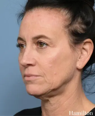 Deep Plane Facelift before at Hamilton Facial Plastic Surgery in Greenwood, IN