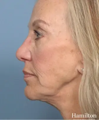 Facelift before at Hamilton Facial Plastic Surgery in Greenwood, IN