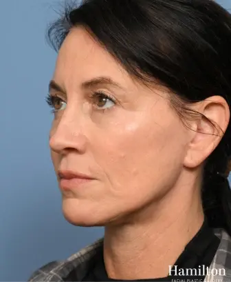 Hamilton Facial Plastic Surgery after — Indianapolis, IN