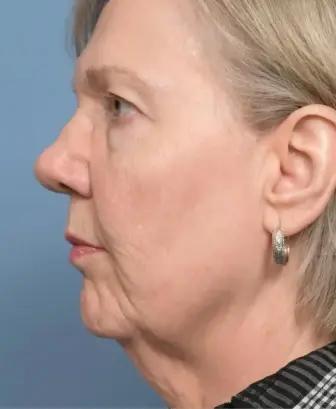 Mini Facelift before at Hamilton Facial Plastic Surgery in Greenwood, IN