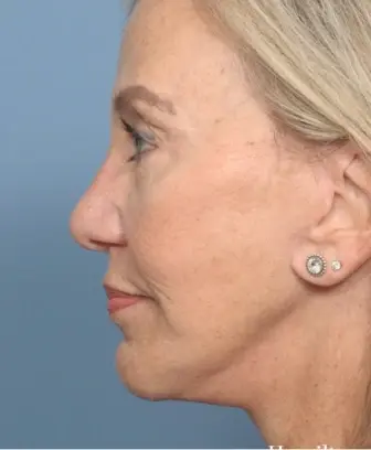 Hamilton Facial Plastic Surgery after — Indianapolis, IN