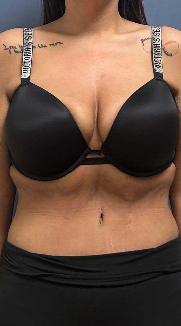 Burt & Will Plastic Surgery and Dermatology tummy tuck after — Plainfield, IL