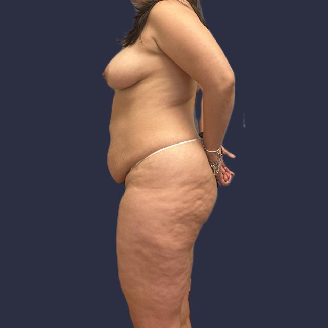 Tummy Tuck before at Burt & Will Plastic Surgery and Dermatology in Plainfield, IL