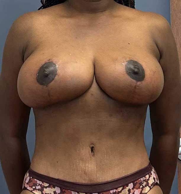 Burt & Will Plastic Surgery and Dermatology mommy makeover after — Plainfield, IL