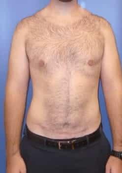 Burt & Will Plastic Surgery and Dermatology tummy tuck after — Plainfield, IL