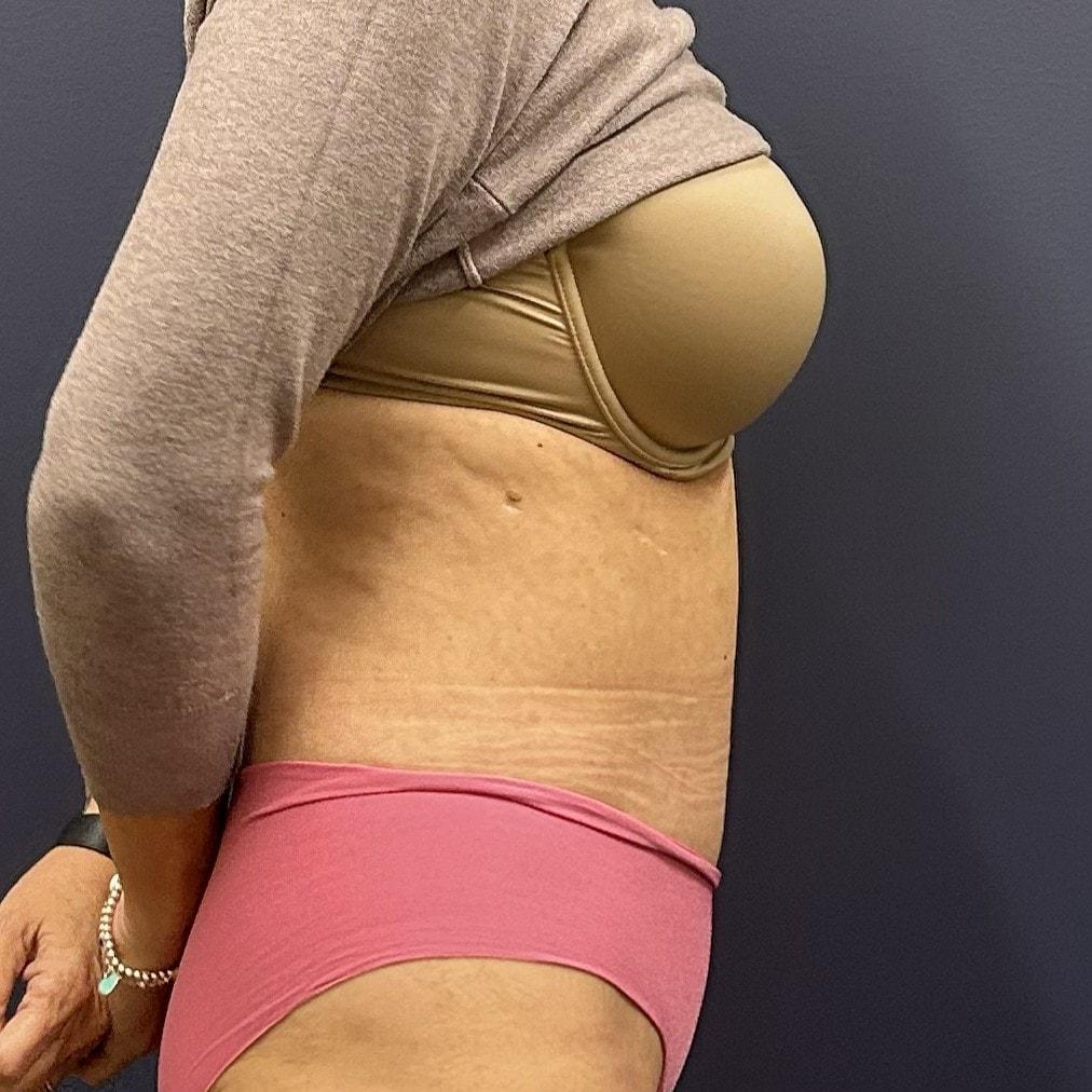 Burt & Will Plastic Surgery and Dermatology tummy tuck after — Plainfield, IL