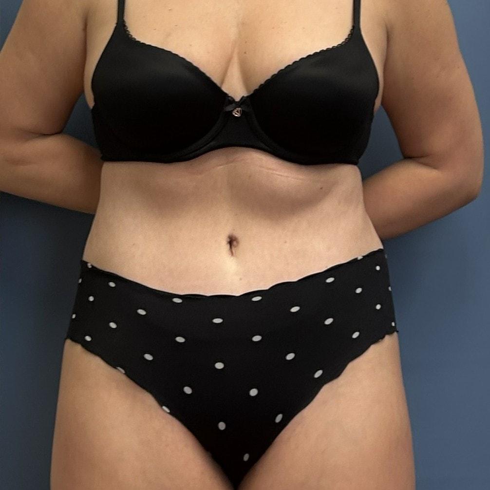 Burt & Will Plastic Surgery and Dermatology tummy tuck after — Plainfield, IL