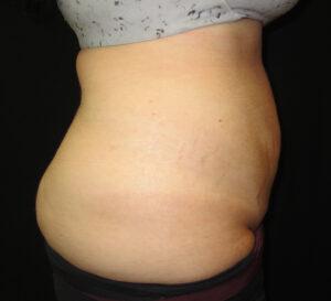 Liposuction after at Port City Plastic Surgery - Charleston in Charleston, SC