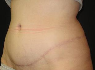 Mommy Makeover after at Port City Plastic Surgery - Charleston in Charleston, SC