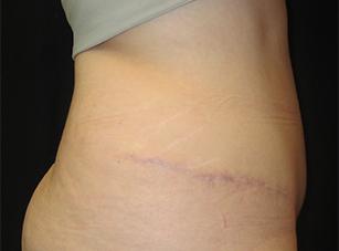 Mommy Makeover after at Port City Plastic Surgery - Charleston in Charleston, SC