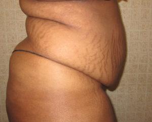 Mini Tummy Tuck before at Port City Plastic Surgery - Charleston in Charleston, SC