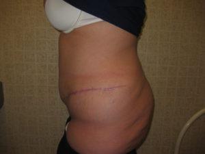 Port City Plastic Surgery - Charleston after — Charleston, SC
