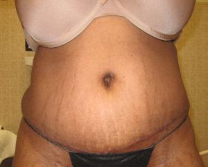 Mommy Makeover after at Port City Plastic Surgery - Charleston in Charleston, SC