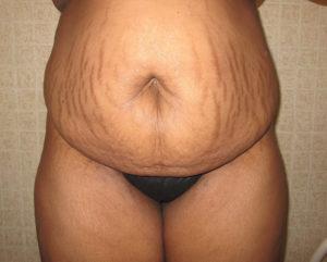 Mommy Makeover before at Port City Plastic Surgery - Charleston in Charleston, SC