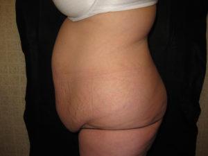 Mommy Makeover before at Port City Plastic Surgery - Charleston in Charleston, SC