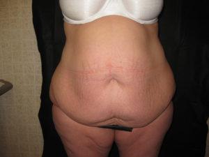 Mommy Makeover before at Port City Plastic Surgery - Charleston in Charleston, SC