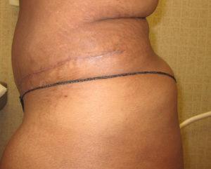 Port City Plastic Surgery - Charleston after — Charleston, SC