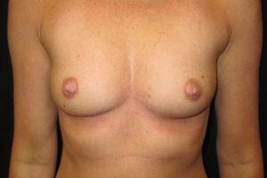 Breast Augmentation before at Port City Plastic Surgery - Charleston in Charleston, SC