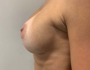 Breast Augmentation after at Port City Plastic Surgery - Charleston in Charleston, SC