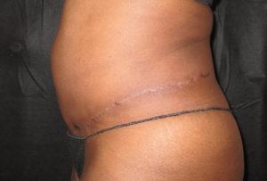 Port City Plastic Surgery - Charleston tummy tuck after — Charleston, SC