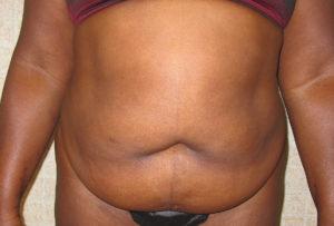 Mommy Makeover before at Port City Plastic Surgery - Charleston in Charleston, SC